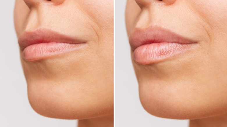 woman with lip lines