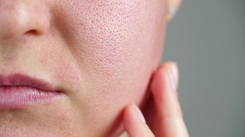 Close up on skin with enlarged pores