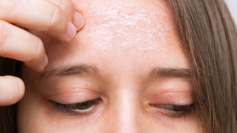 Woman with severely dry skin