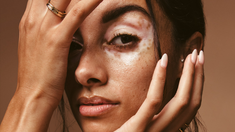 Woman with vitiligo around her eye