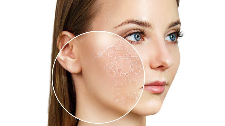 Young woman showing zoomed circle of dry skin before moisturizing