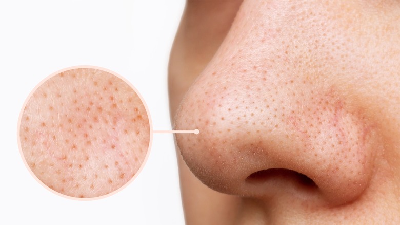 The Black Dots In Your Pores May Not Be Blackheads After All
