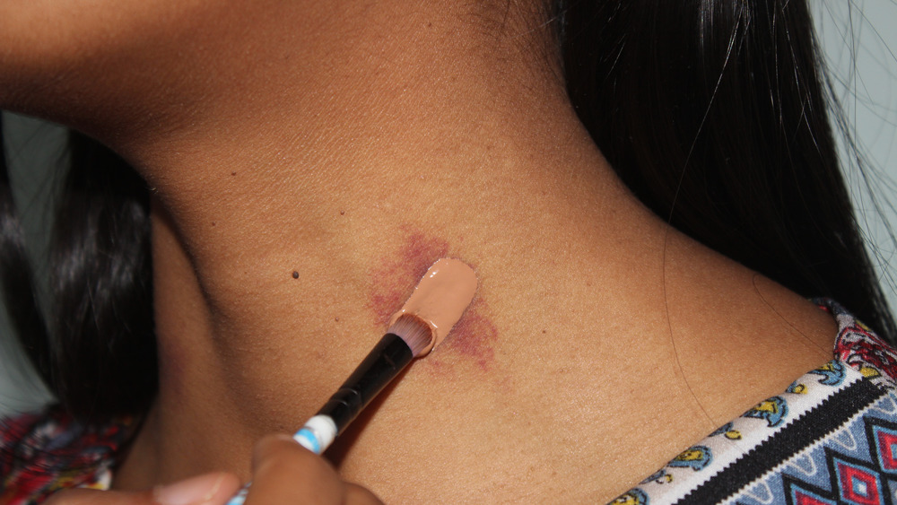 woman putting makeup on hickey
