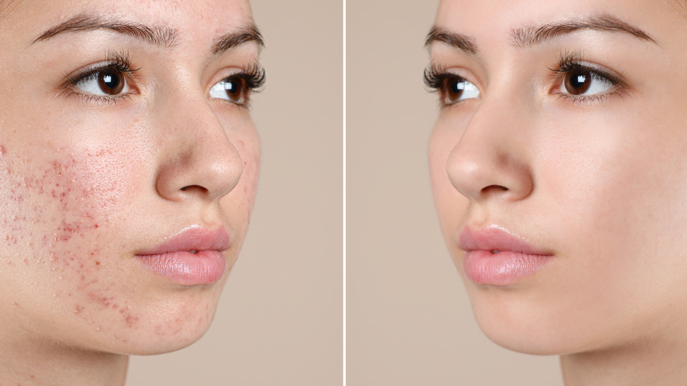 Facial Scars – Scar Makeup to Cover Scars