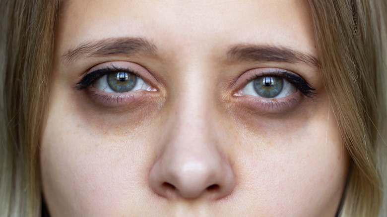 woman with dark circles under eyes