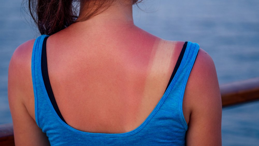 Woman with sunburn