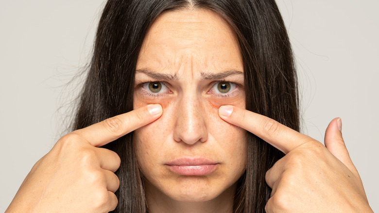 woman pointing at eye bags