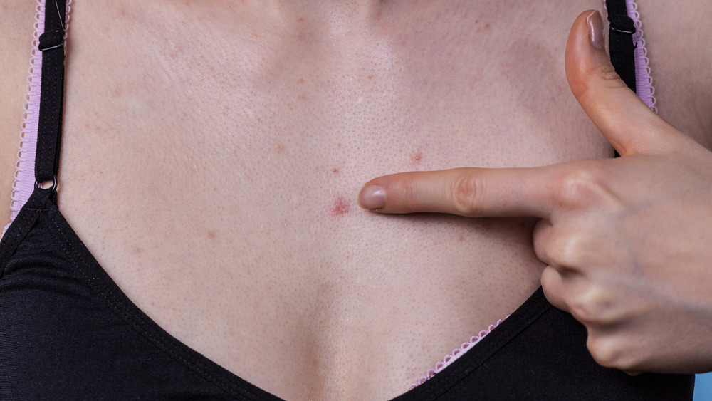 Woman with chest acne