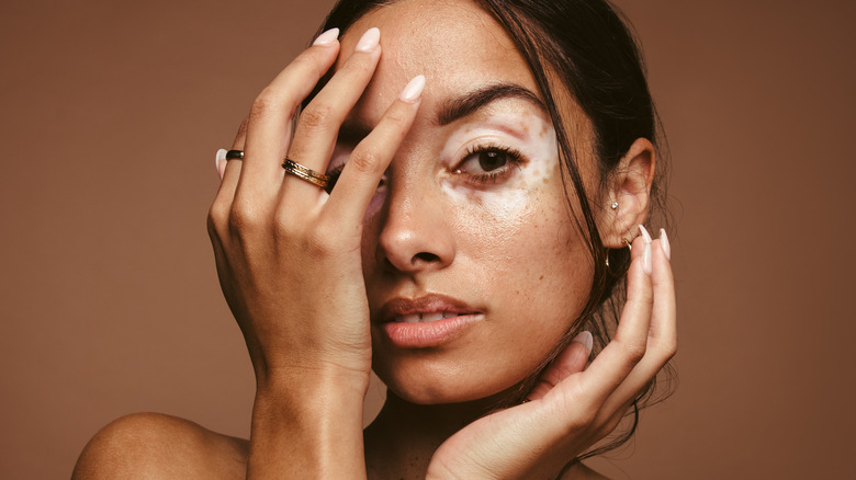 makeup free model with vitiligo