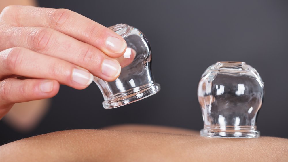 Cupping therapy