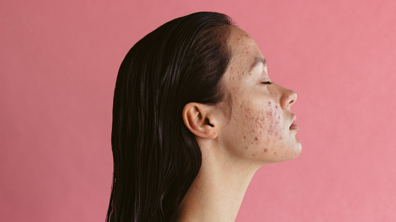 Woman with acne