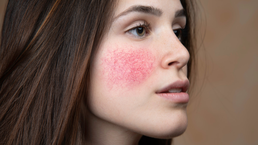 Brunette woman with rosacea