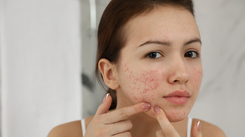 Woman with acne 