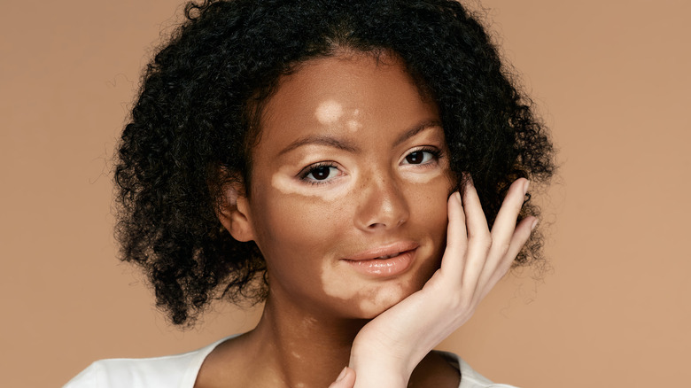 Young woman with vitiligo on her face and hand