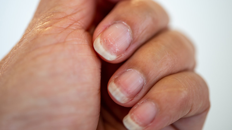 Pitted nails due to severe atopic dermatitis - Stock Image - C056/1057 -  Science Photo Library