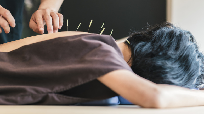 woman receiving acupuncture