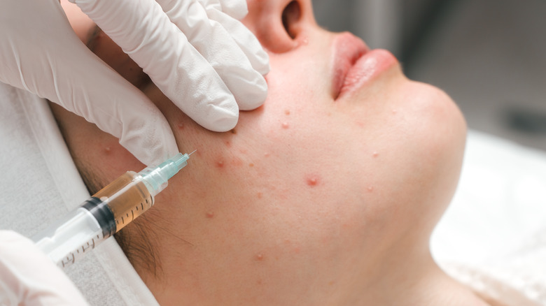 Woman getting cortisone shots for acne