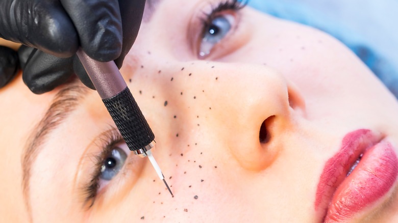 Woman getting freckles tattooed