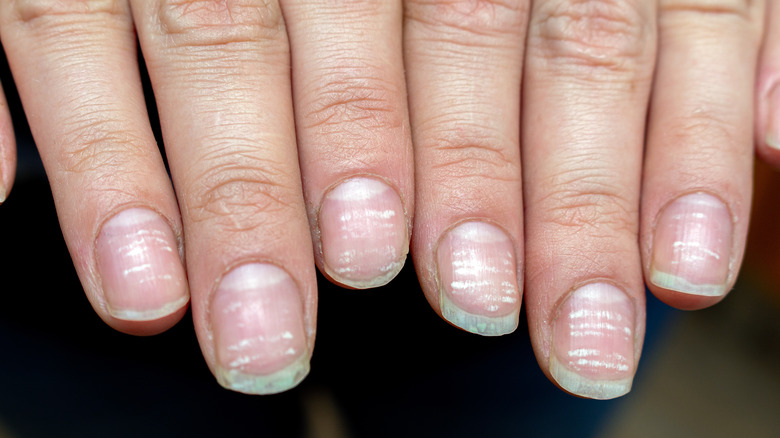 Fingernails with grooved lines