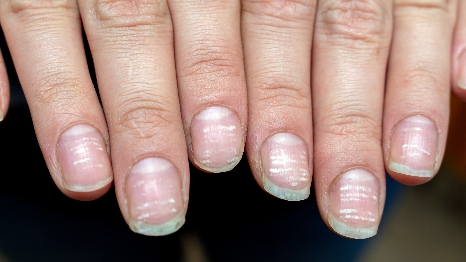 The Truth About 'Covid Nails'