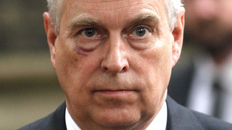 Prince Andrew with black eye