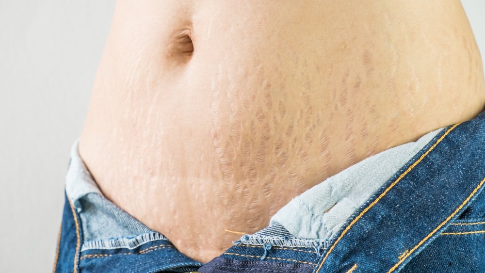 stretch marks on a belly