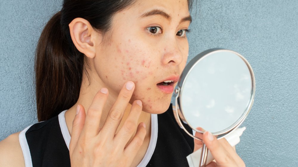 Woman with acne