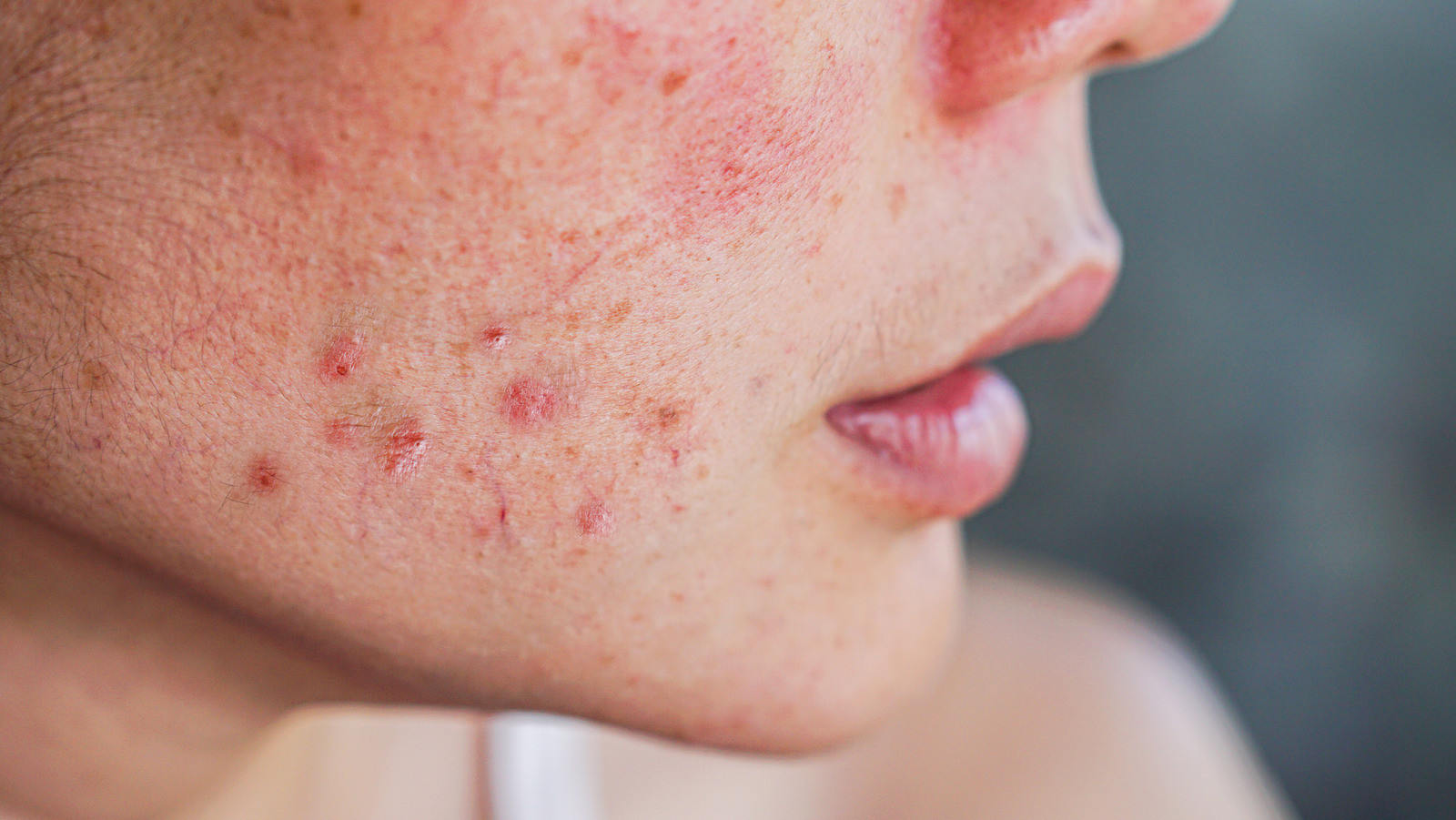 The Ultimate Guide For Getting Rid Of Inflammatory Acne