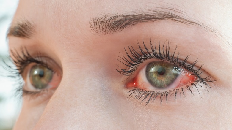 Eye redness 