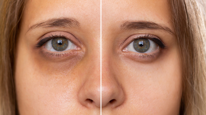 before/after dark under eyes