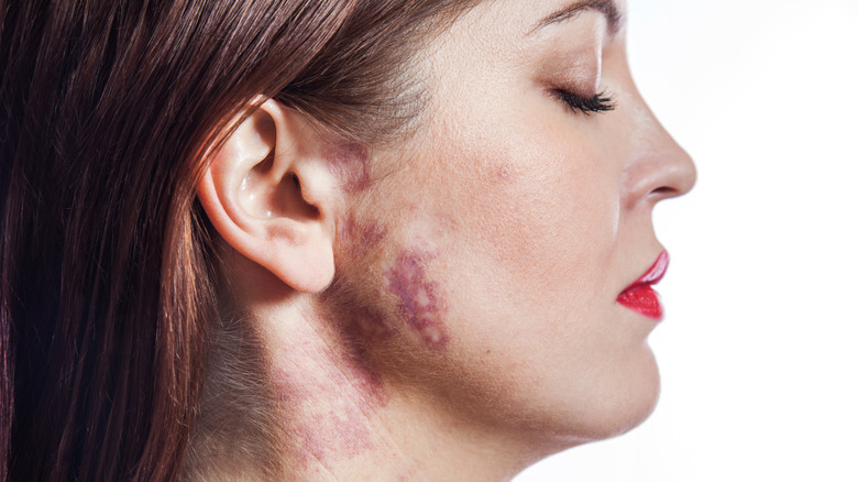 Woman with port wine stain