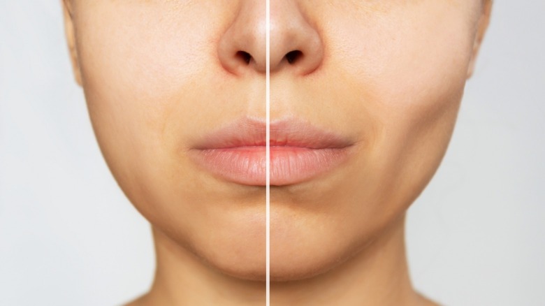 Buccal fat removal before and after