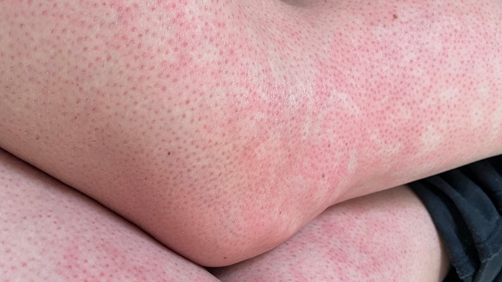 These Everyday Items Could Be Giving You Toasted Skin Syndrome Here's What To Know