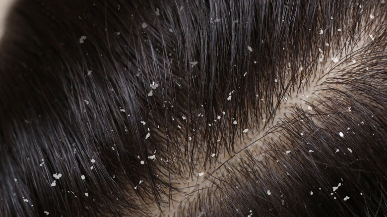 Woman with dandruff 