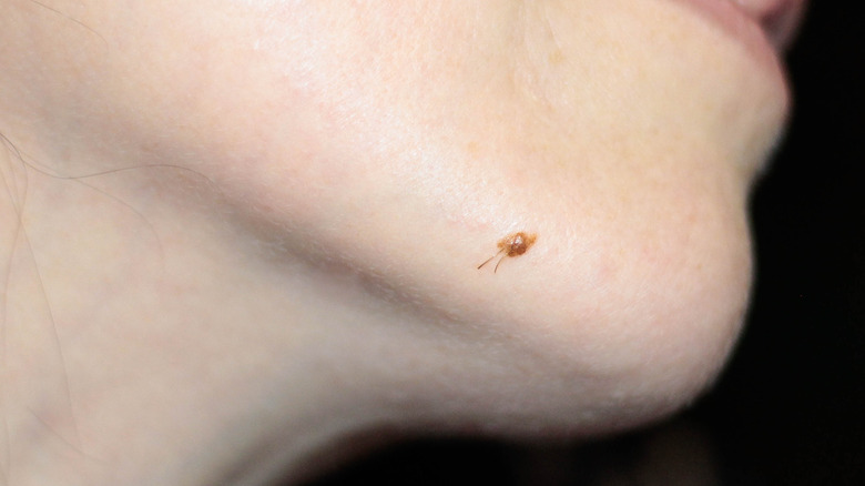 Mole on someone's chin 