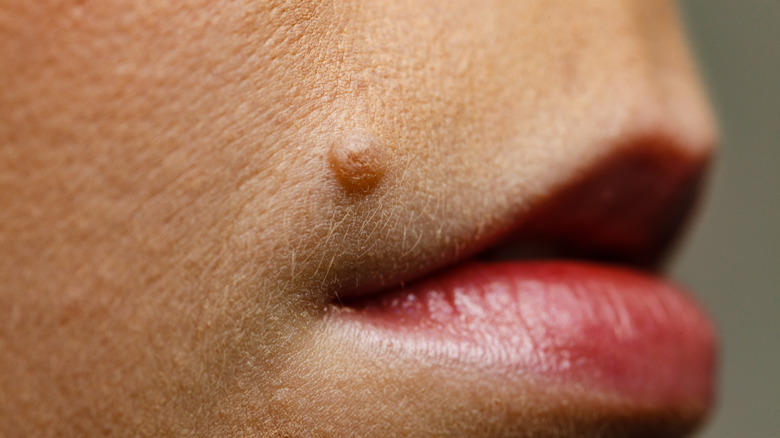 Closeup of mole on woman's lips