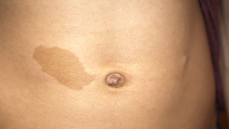 birthmark on stomach