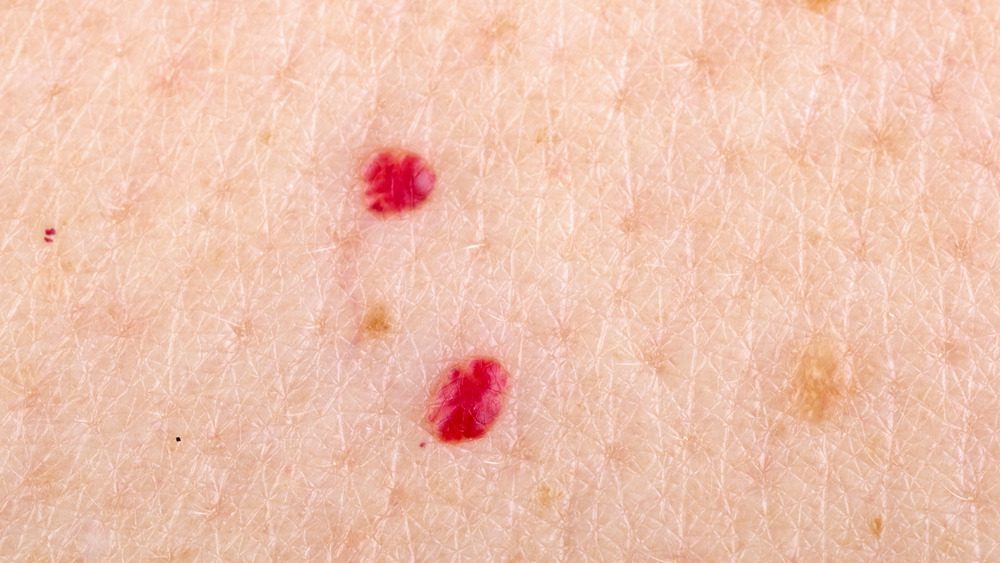 Close up of red bumps on skin 