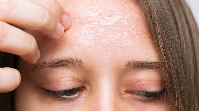 Woman's forehead with dry skin