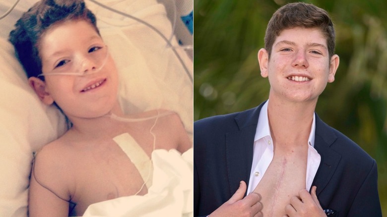 Photos of Paul Baier with his scar