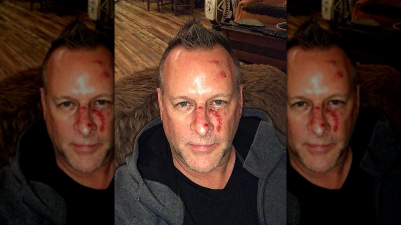 Dave Coulier selfie with scratches and wounds on his face