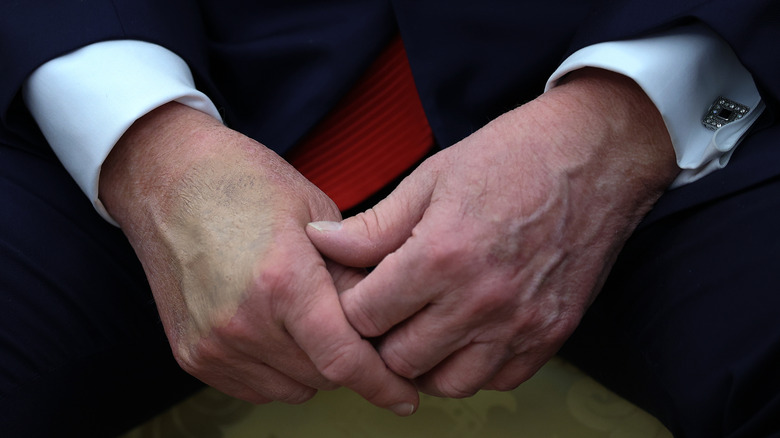 Closeup of Donald Trump's hands with makeup applied over a bruise
