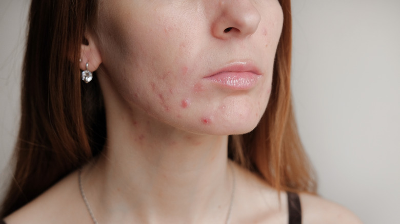 Woman with acne on her face