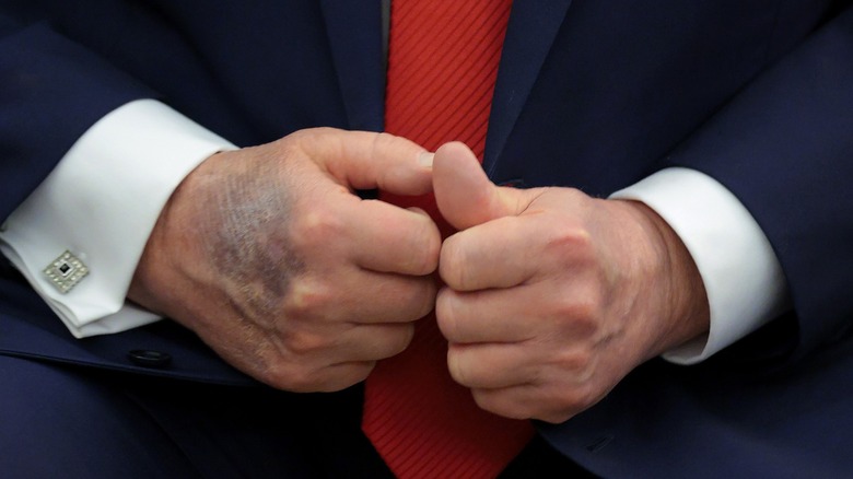 President Donald Trump's bruised hands