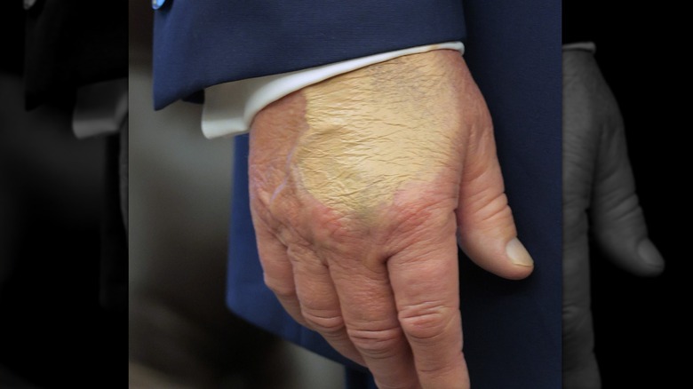 A patch of discolored skin on the back of President Donald Trump's hand