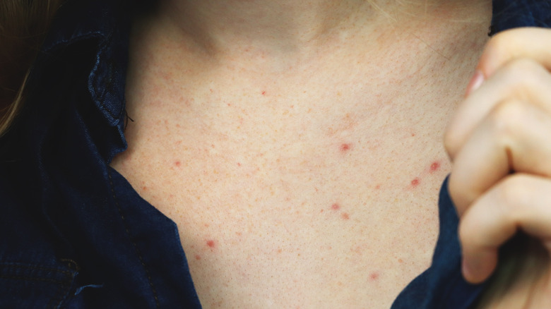 Woman sweat pimples on chest