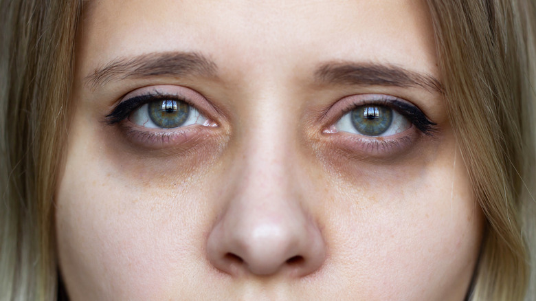 Woman with dark circles