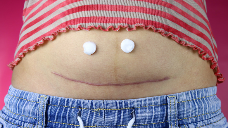 Postpartum belly with C-section scar
