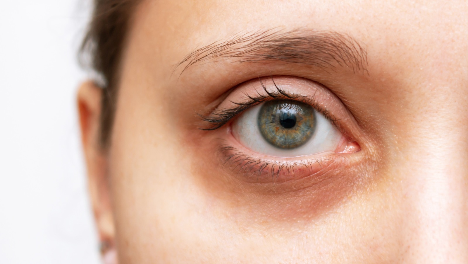 What Causes Yellow Circles Under Your Eyes?