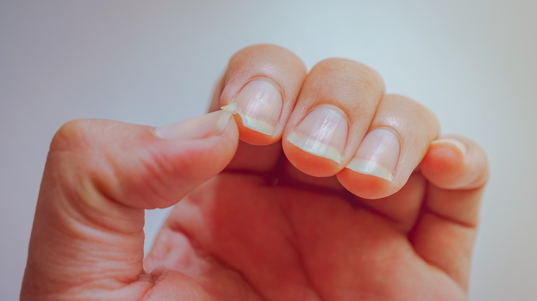 Closeup of split nails